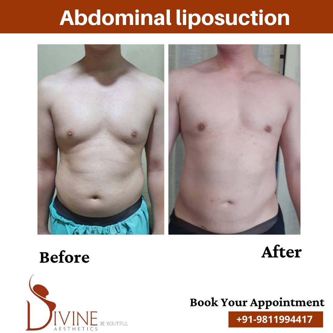 Abdominal Liposuction before after 1 March 2022