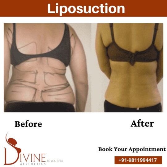 Back Liposuction Surgery before after