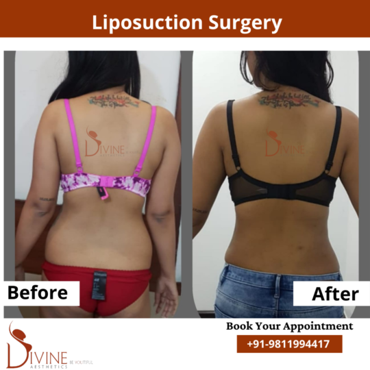 Back Liposuction before after