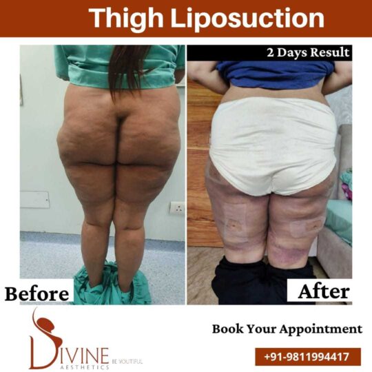 Brazilian Buttock Lift Before After May 2022