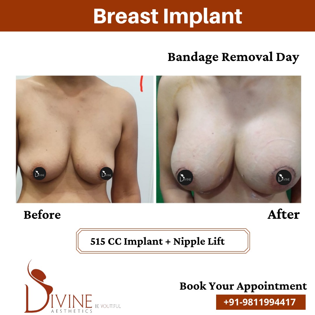 Bandage Removal of Breast Implant Result