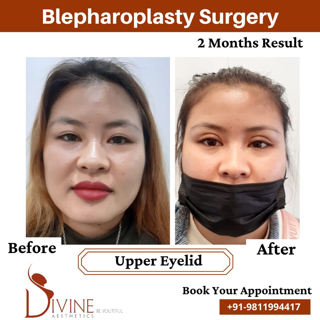 Blepharoplasty before after jan 1