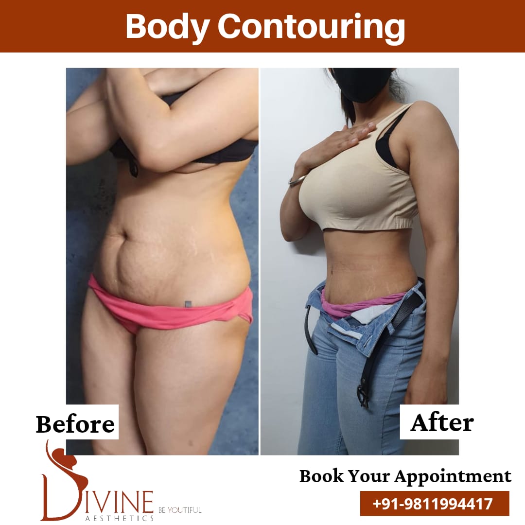 Body Contouring before after result