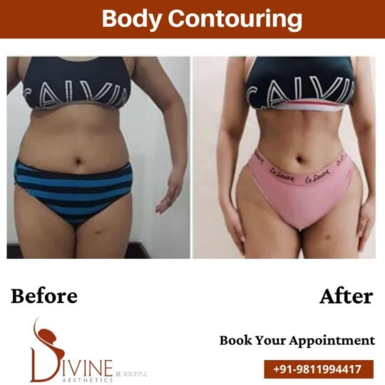 female Body Contouring before after result