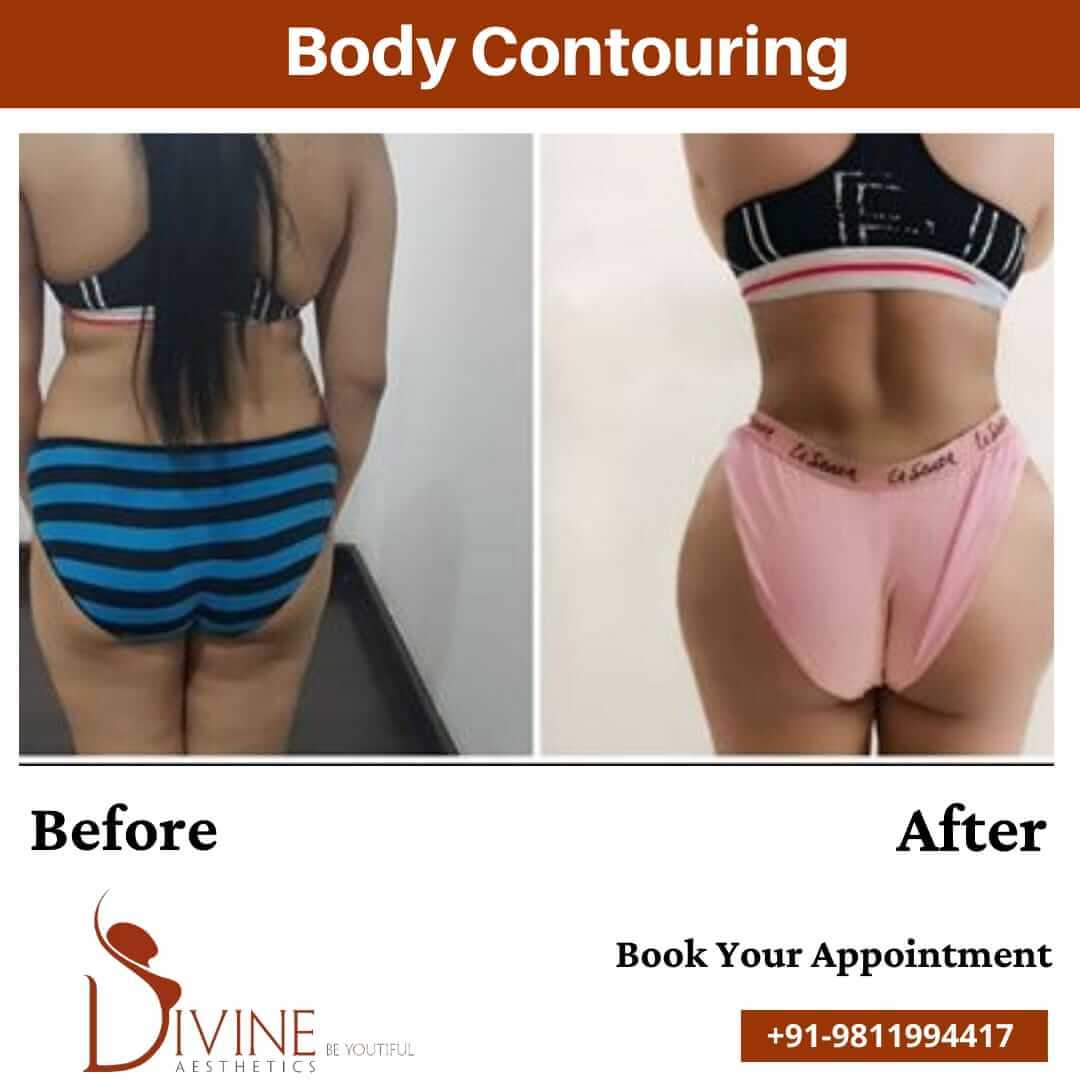 Female Body Contouring before after result
