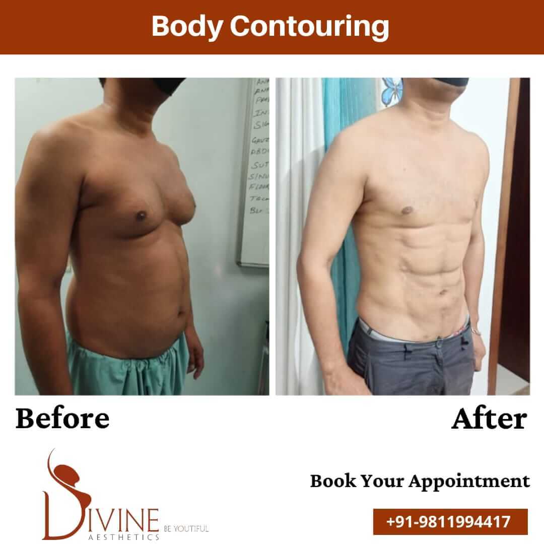 Male Body Contouring before after result