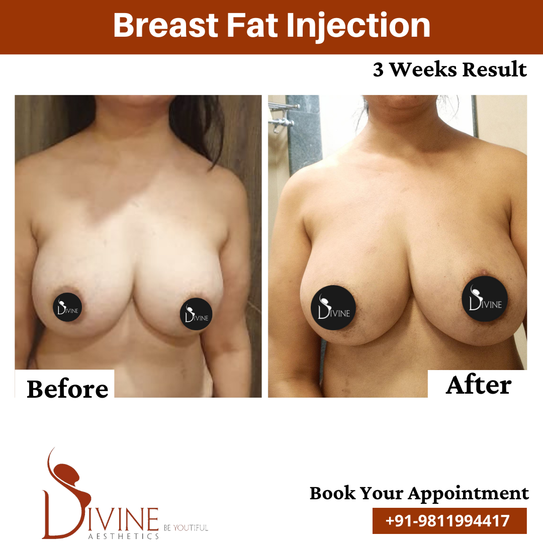 Breast Fat Injection