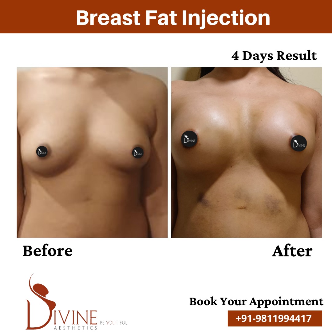 Breast Fat Transfer Before After