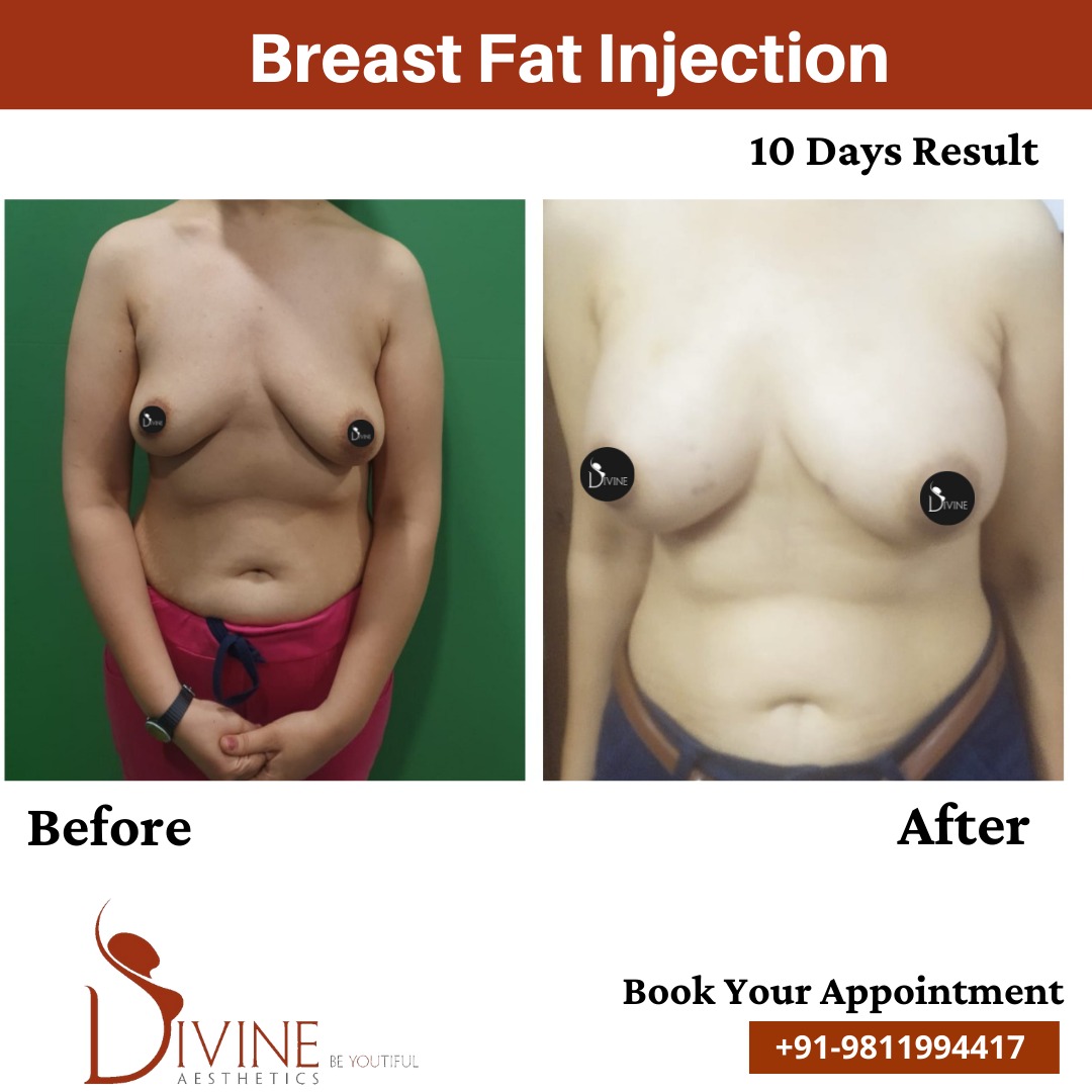Breast Fat Transfer Before After May 22