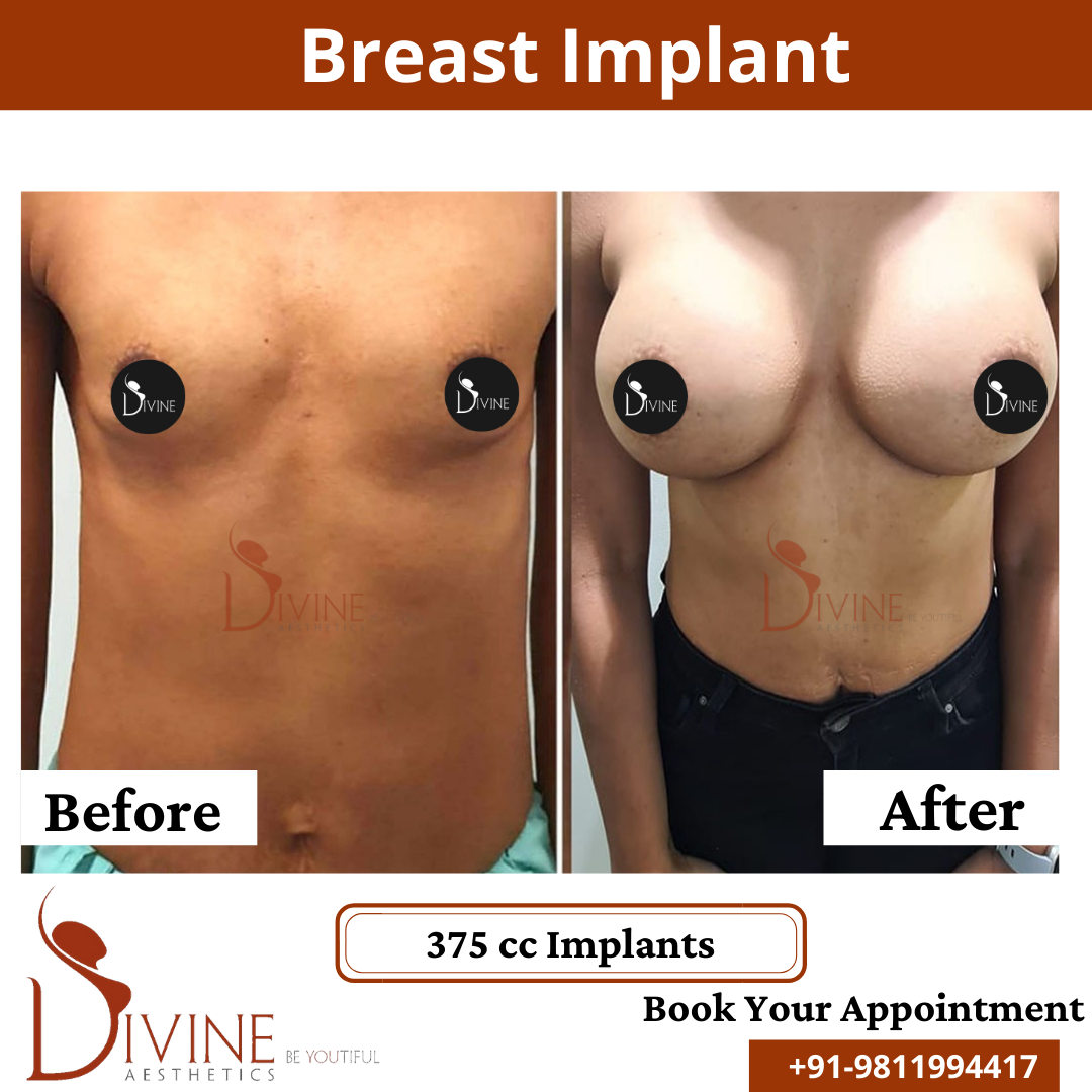 Breast Implant 1