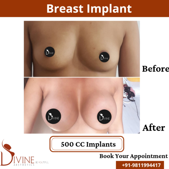 Breast Implant 11