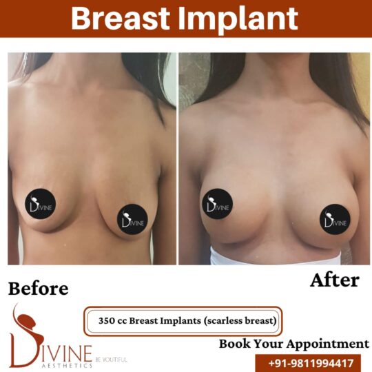 Breast Implant 12