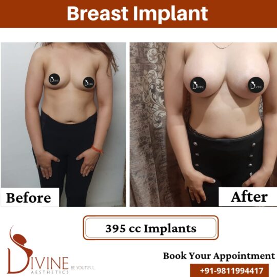 Breast Implant 13