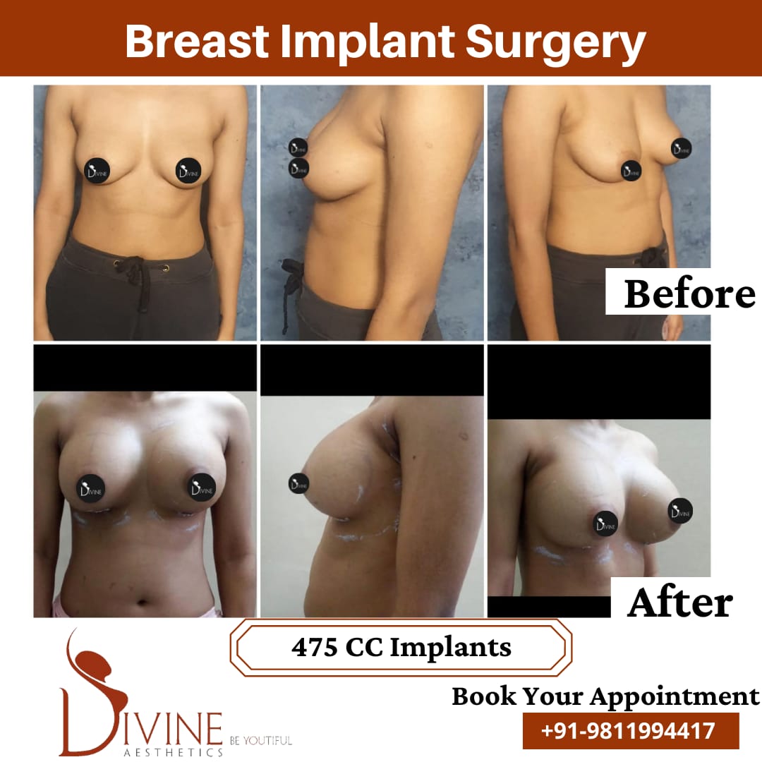 Breast Implant 15