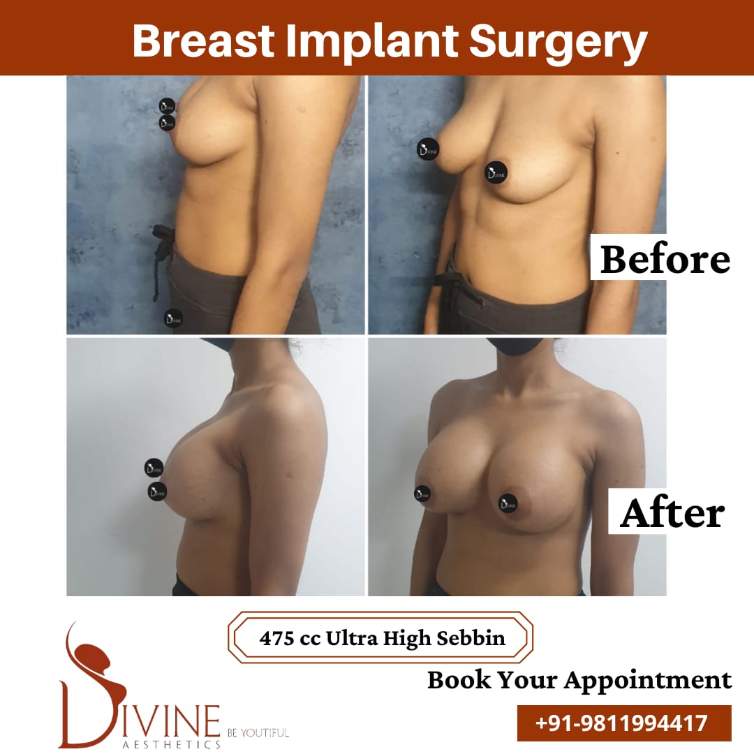 Breast Implant 17