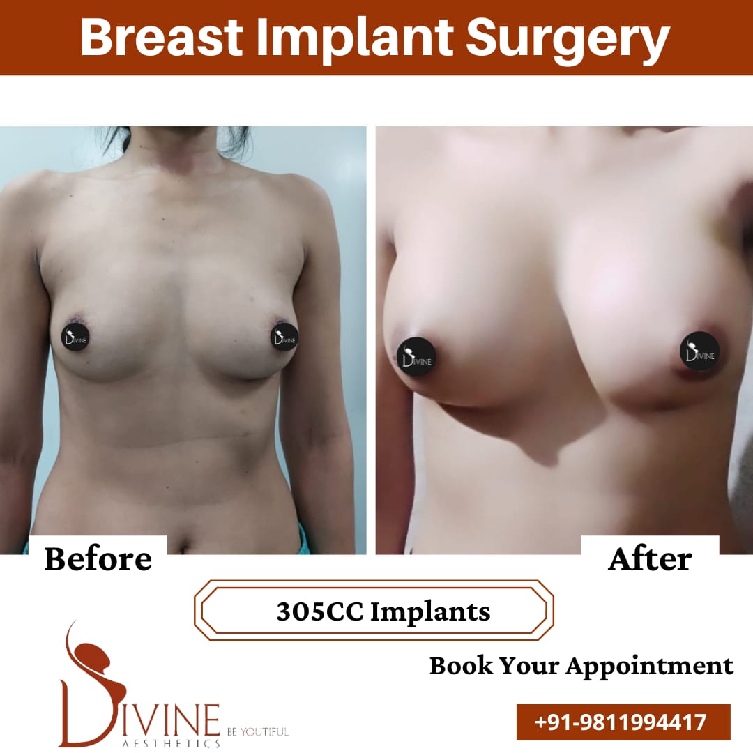 Breast Implant 18