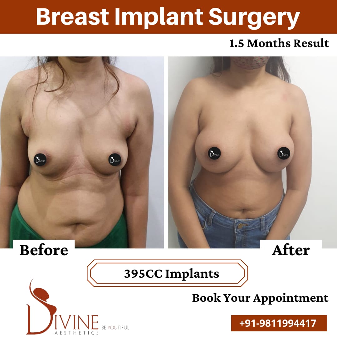 Breast Implant 19