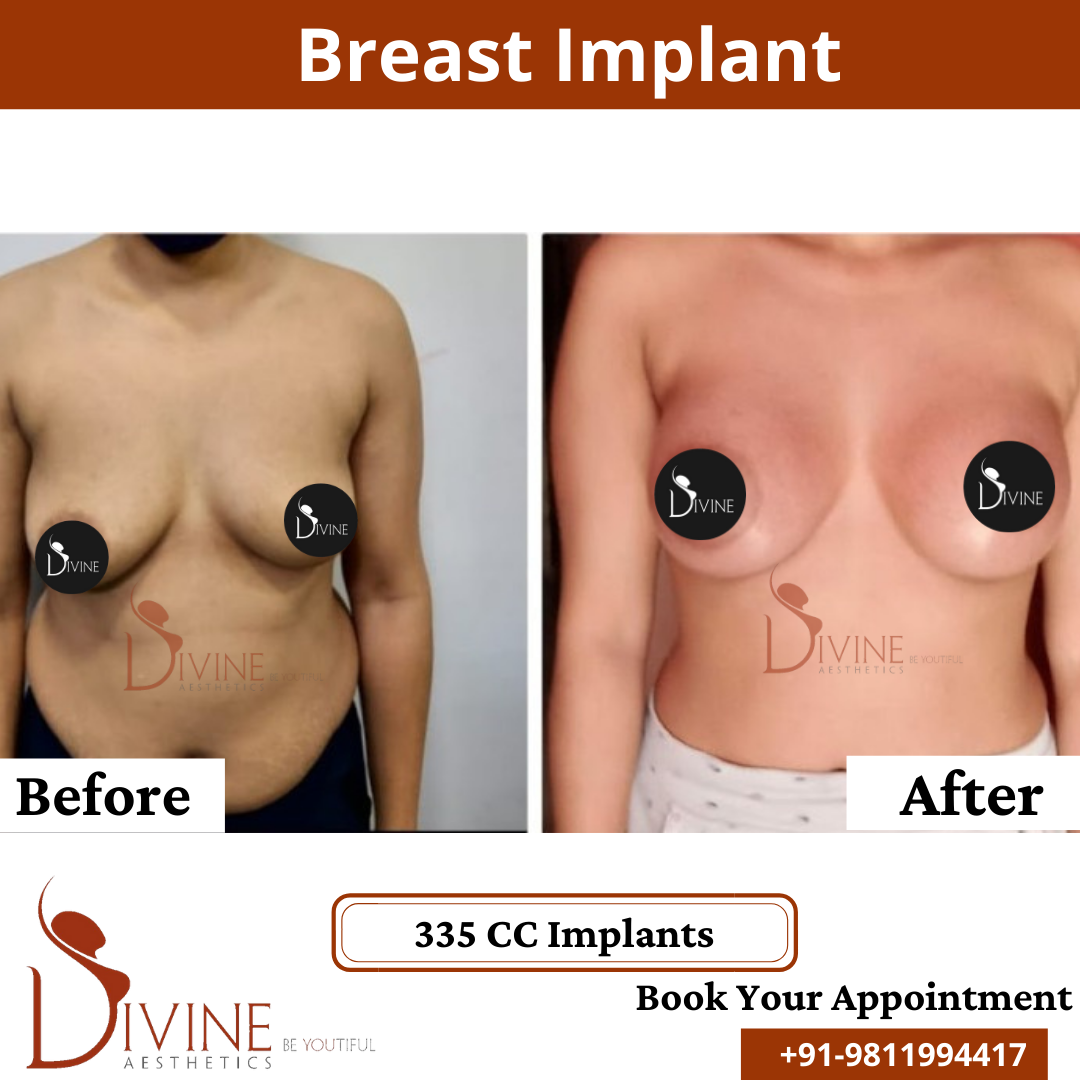 Breast Implant 2