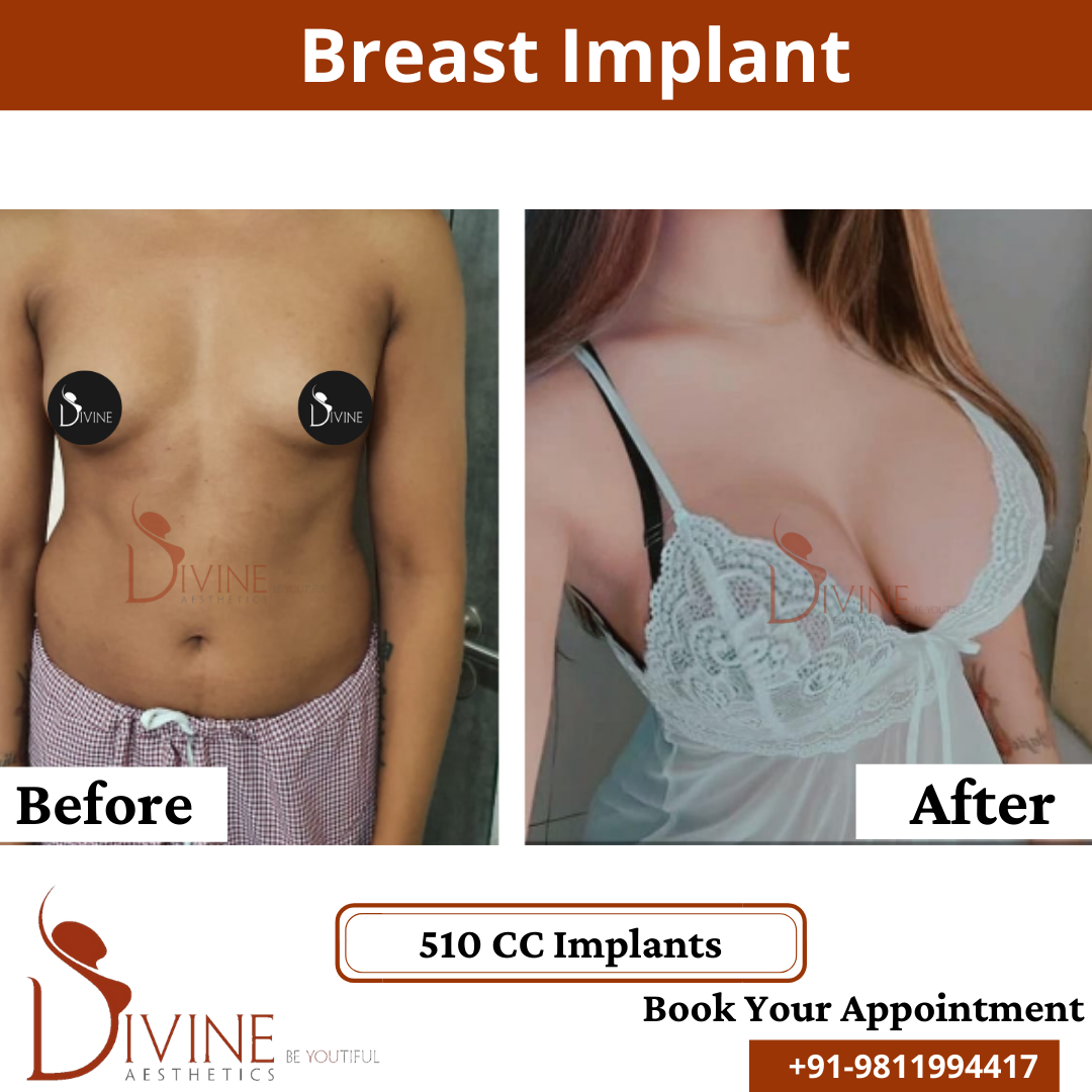 Breast Implant 3