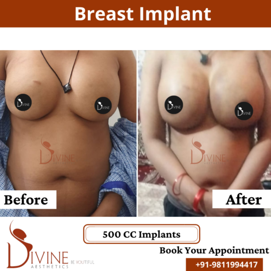 Breast Implant 4