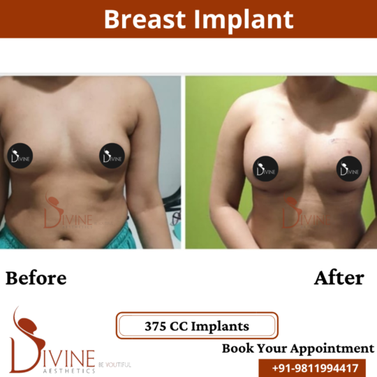 Breast Implant 5