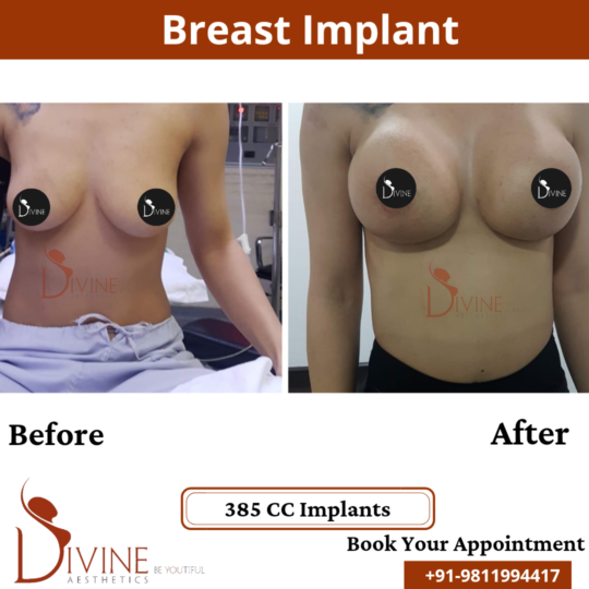 Breast Implant Before After