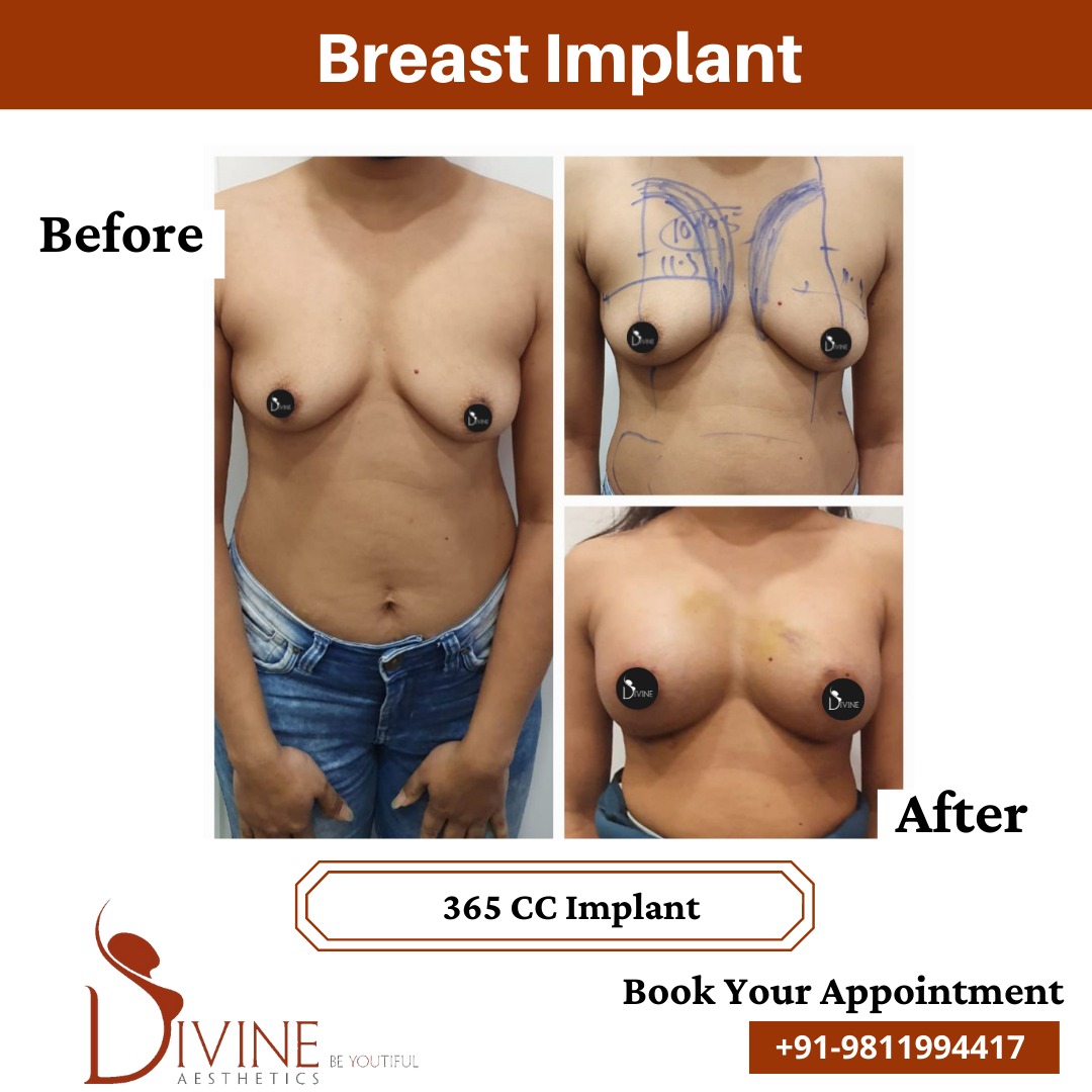 Breast Implant Before After 1 Feb 22