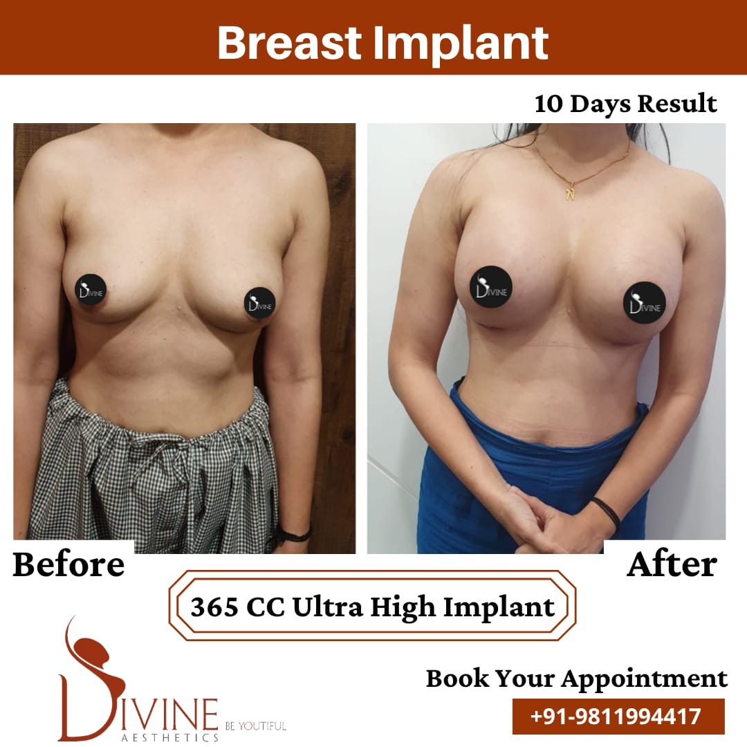 Breast Implant Before After 10 Feb 22