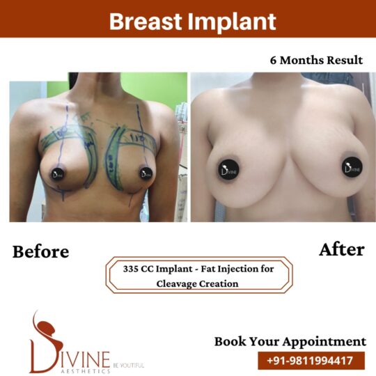 Breast Implant Before After 12 Feb 22
