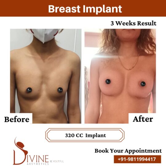 Breast Implant Before After 13 Feb 22