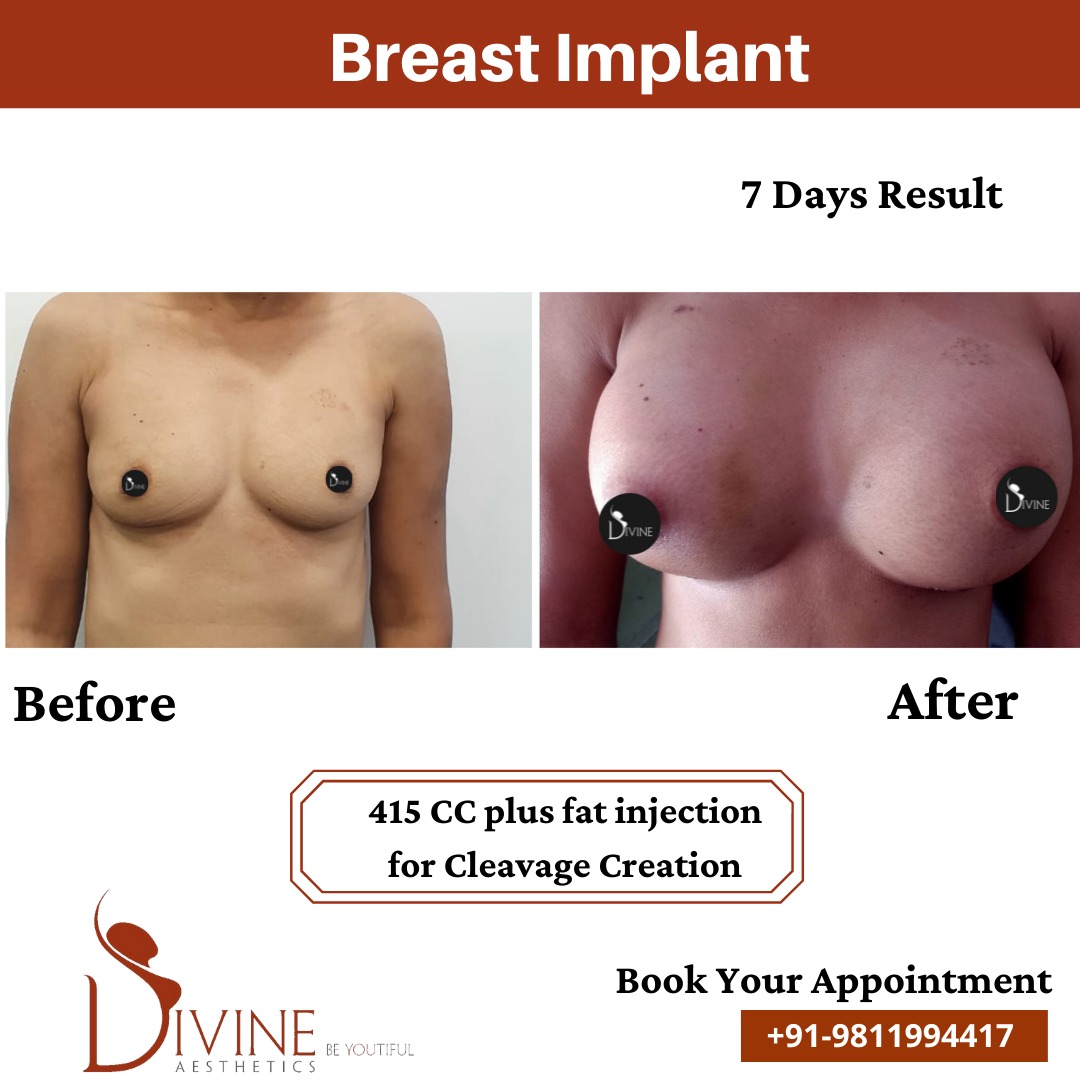 Breast Implant Before After 14 Feb 22