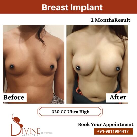 Breast Implant Before After 15 Feb 22