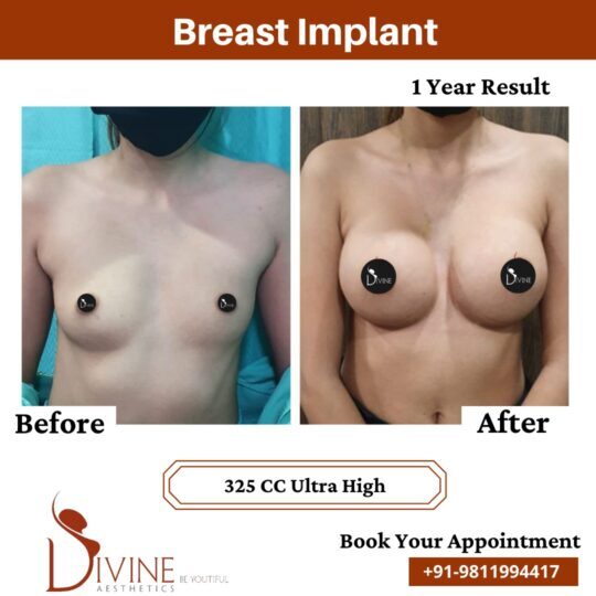 Breast Implant Before After 2 Feb 22