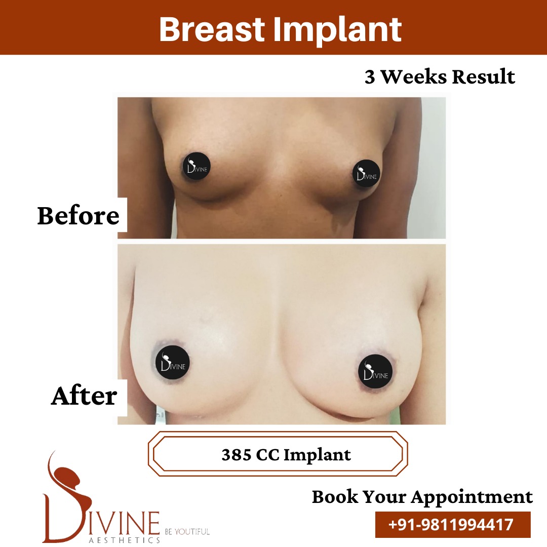 Breast Implant Before After 3 Feb 22