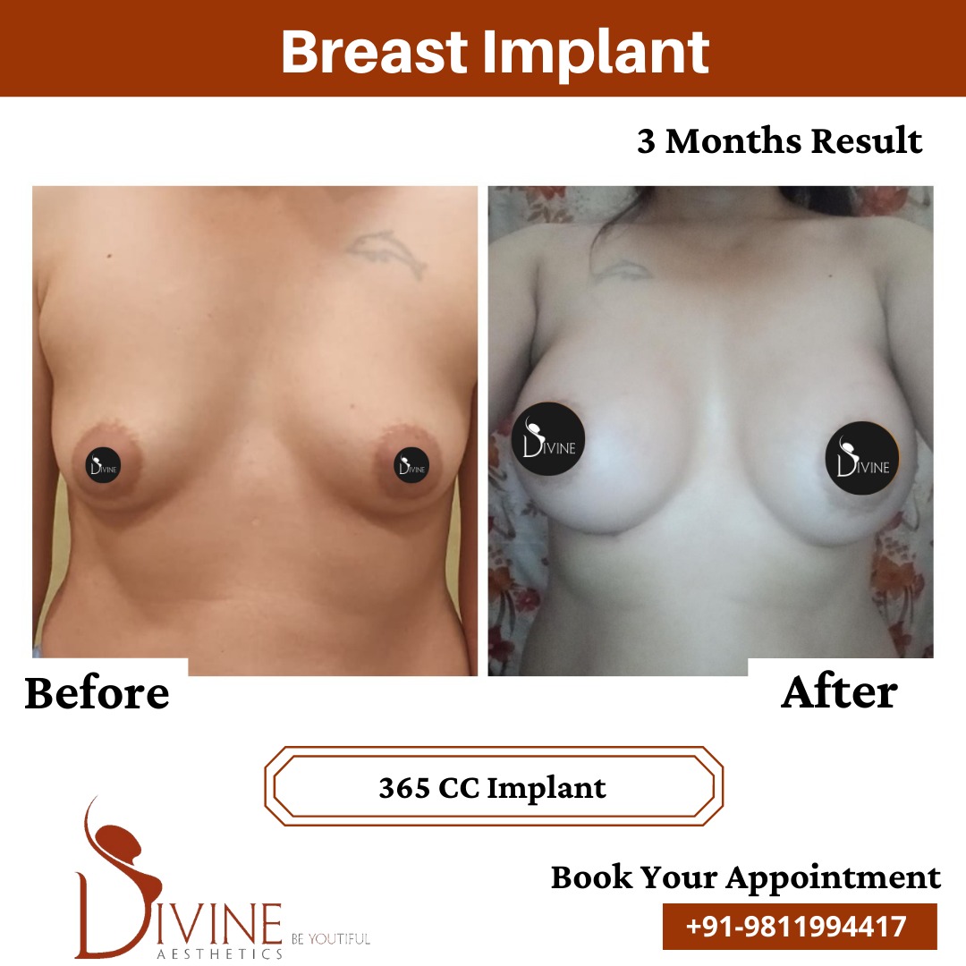 Breast Implant Before After 4 Feb 22