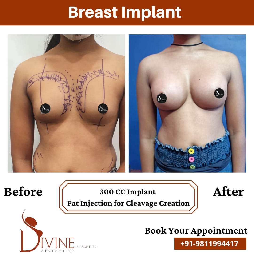 Breast Implant Before After 9 Feb 22