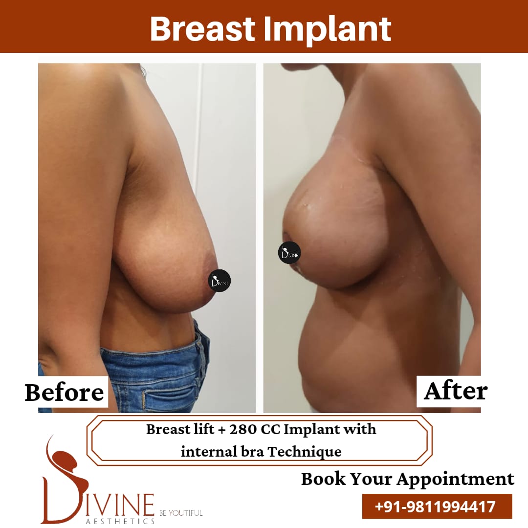 Breast Implant Result 280 CC with Internal Bra Technique