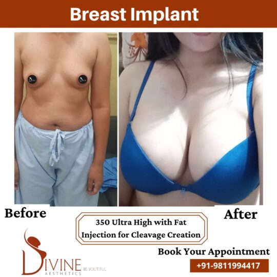 Breast Implant before after 11 March 2022
