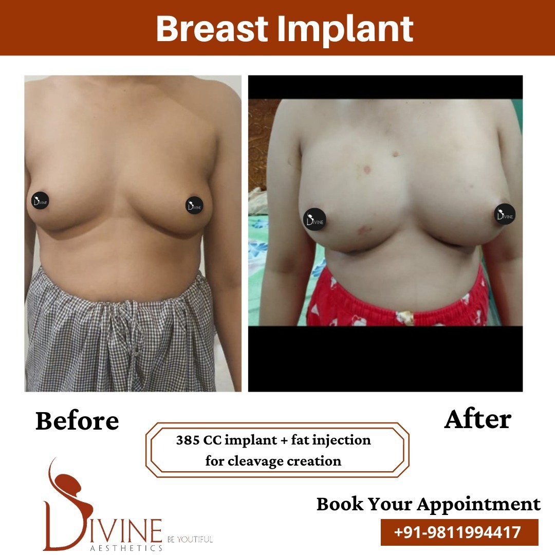 Breast Implant before after 12 March 2022