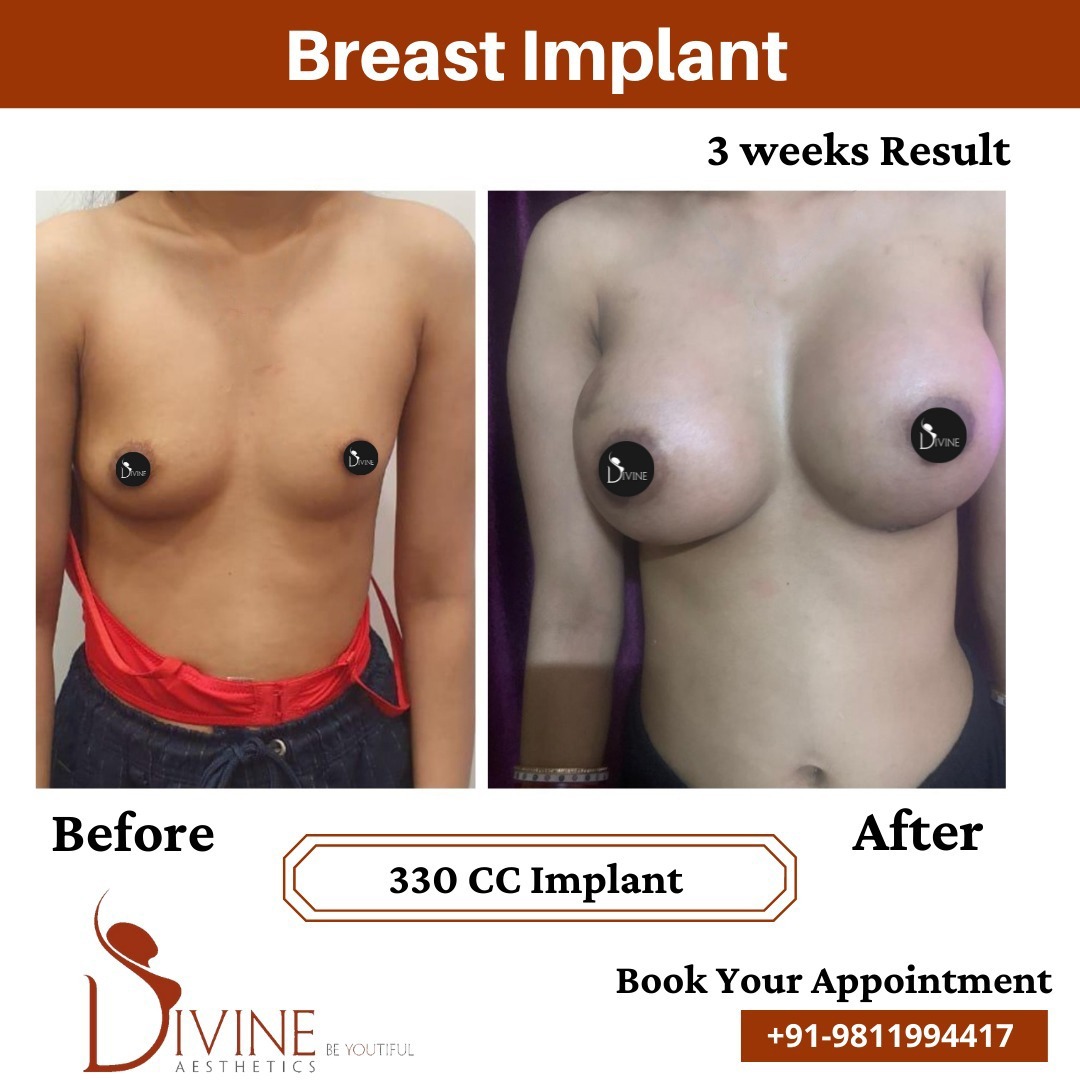 Breast Implant before after 13 March 2022