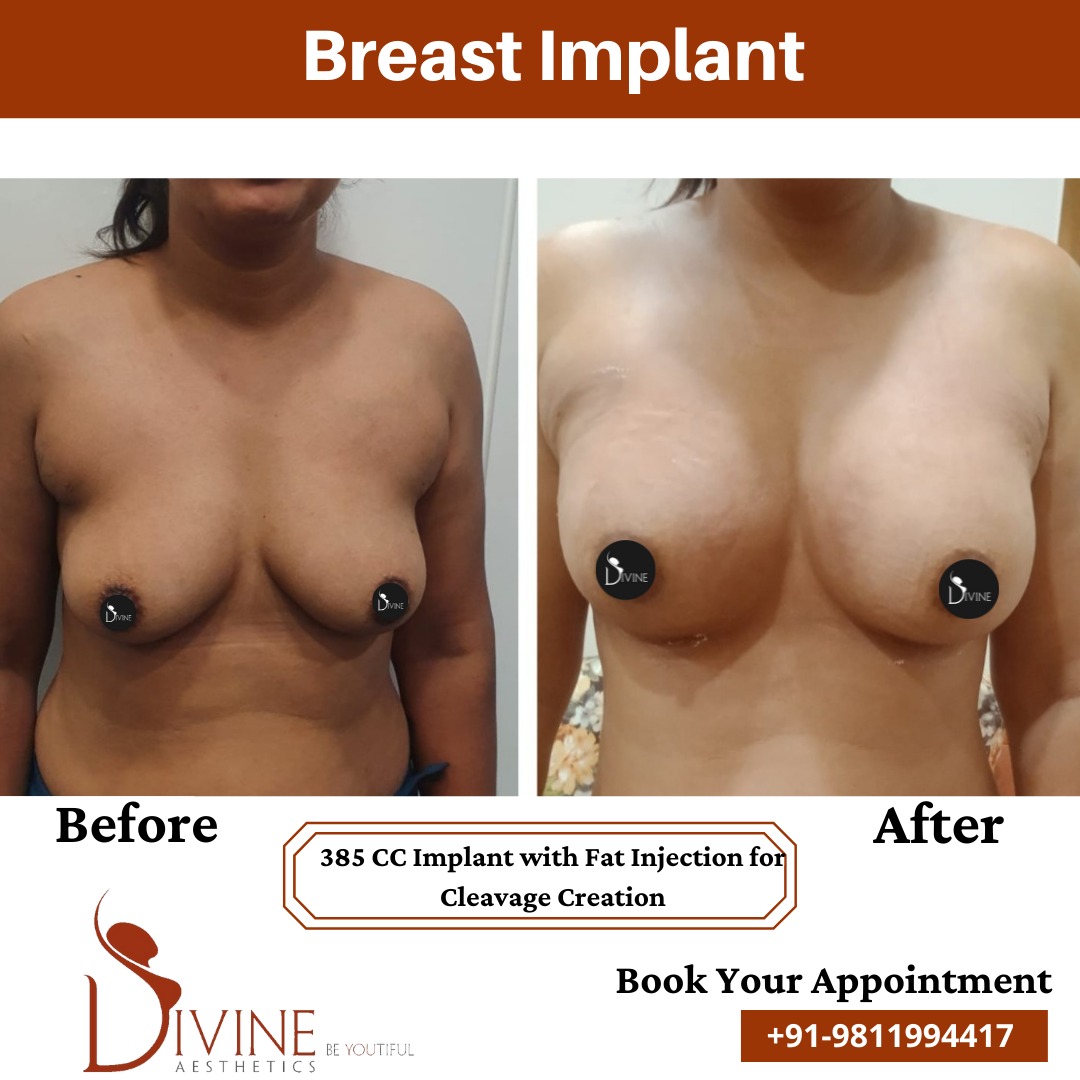 Breast Implant before after 14 March 2022