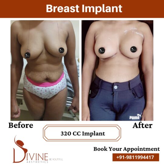 Breast Implant before after 15 March 2022