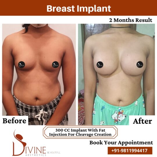 Breast Implant before after 4 March 2022