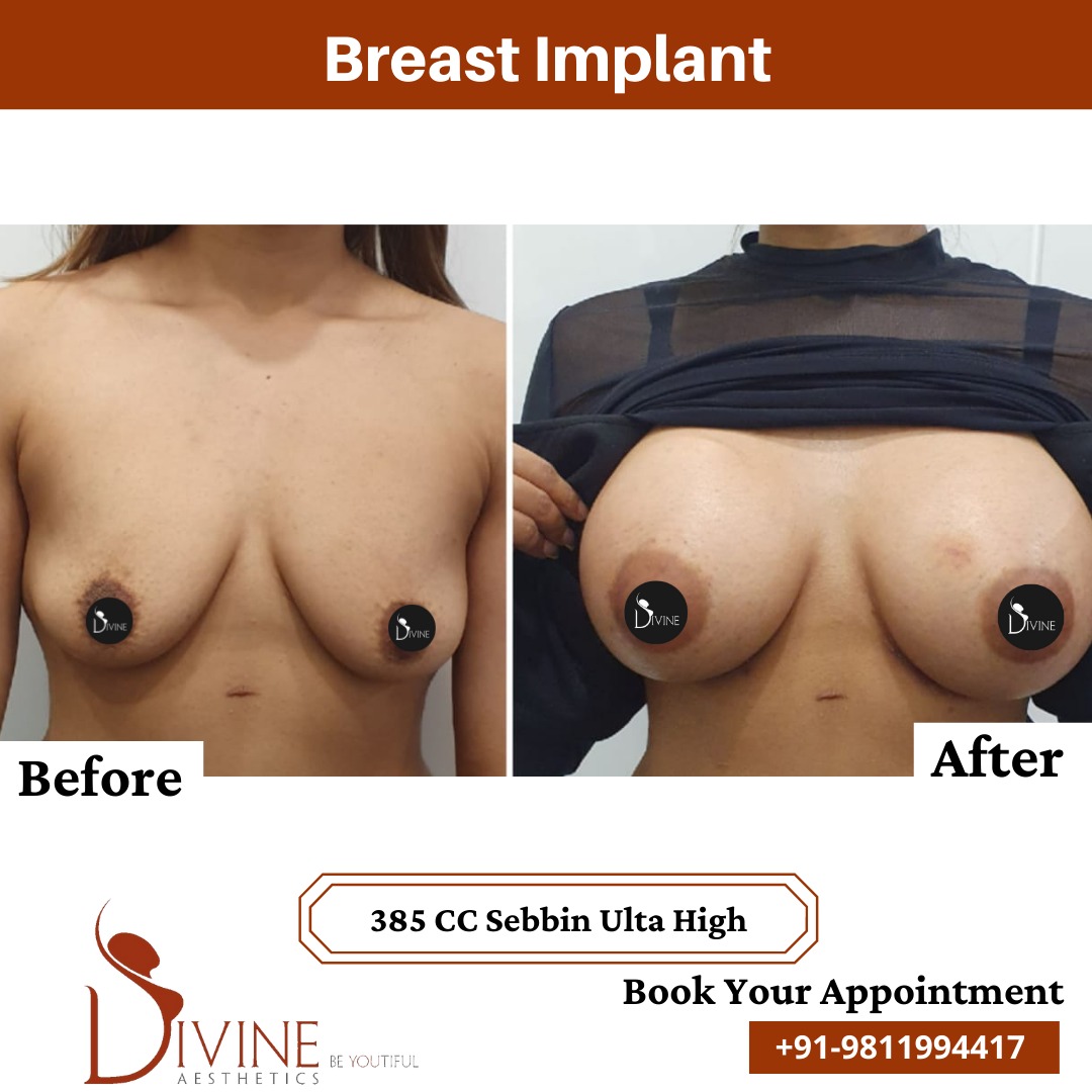 Breast Implant before after 5 March 2022