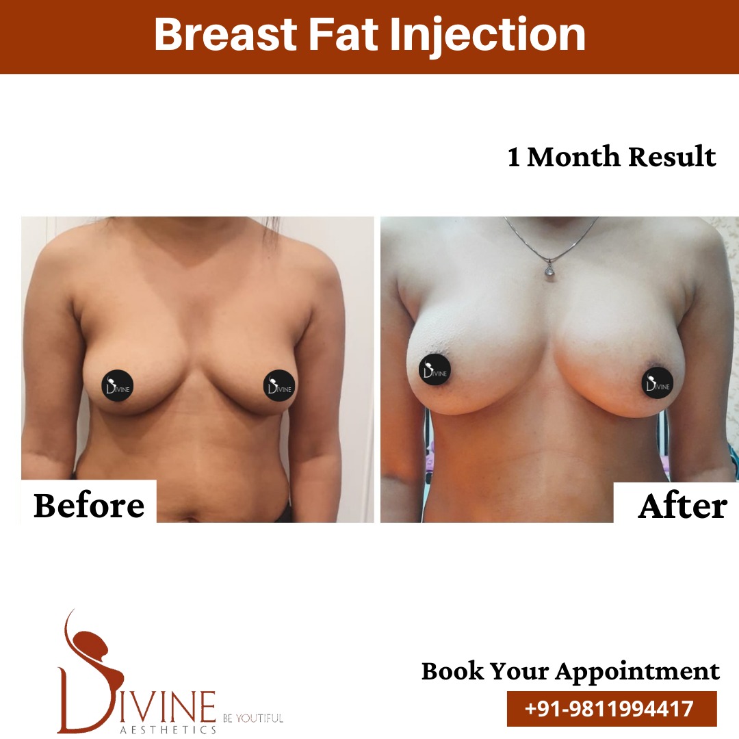 Breast Fat Injection Before After Results