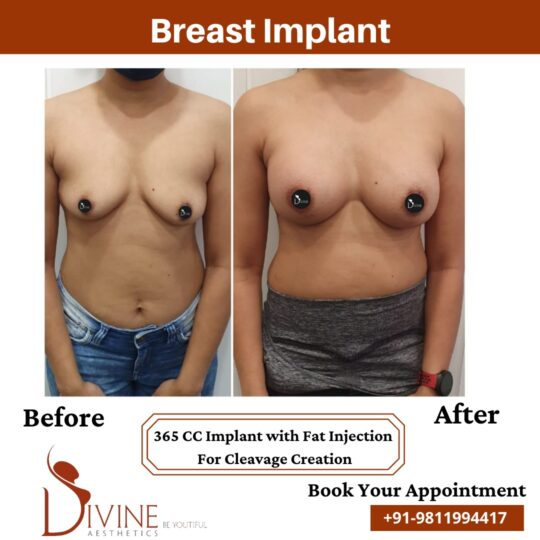 Breast Implant before after 7 March 2022