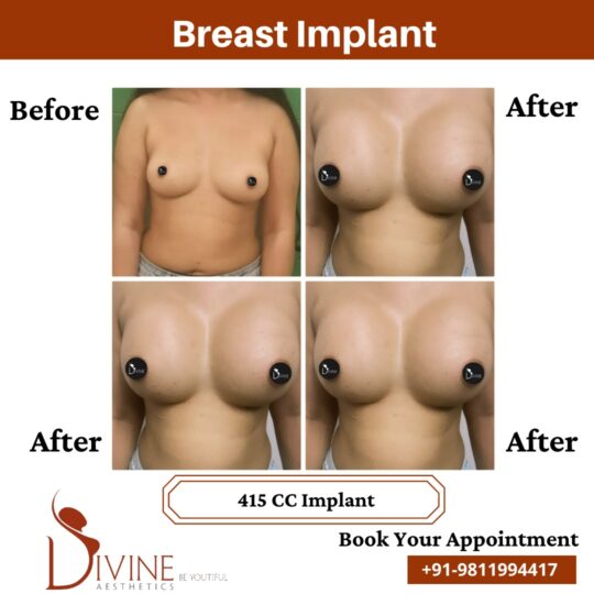 Breast Implant before after 9 March 2022