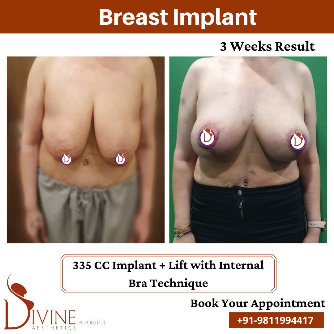 Breast Lift + Breast Implant with Internal Bra Technique