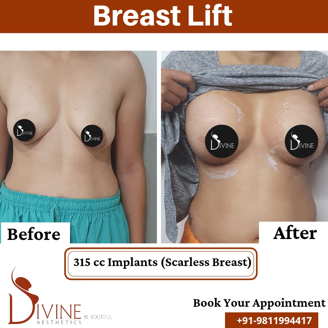 Breast Lift cost in Delhi