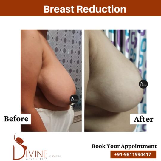 Breast Reduction Surgery Before After 6 Feb 22